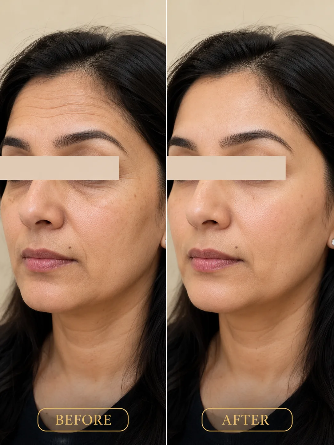 Botox & Wrinkle Care before and after result