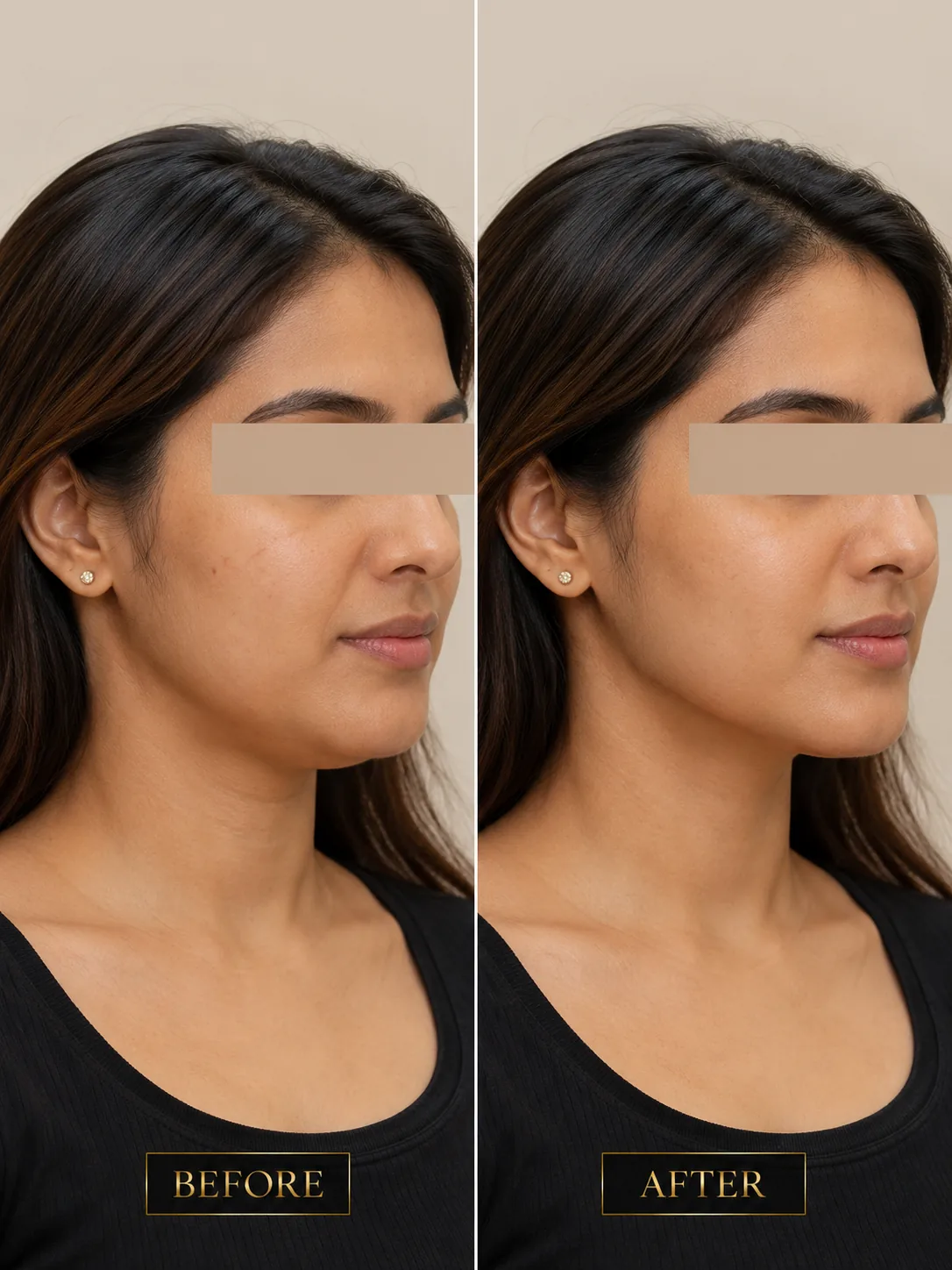 Jawline Contouring before and after result