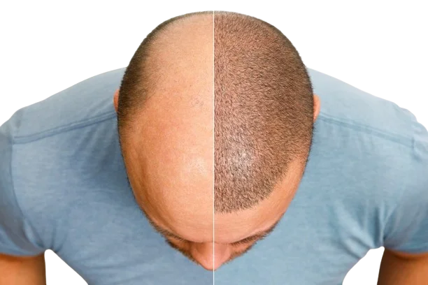 Hair Restoration in Gurgaon at Avenza – Advanced Skin • Hair • Laser • Anti-Ageing
