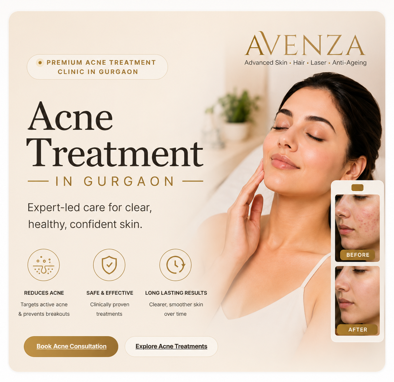 Acne treatment consultation at Avenza in Sector 48 Gurgaon